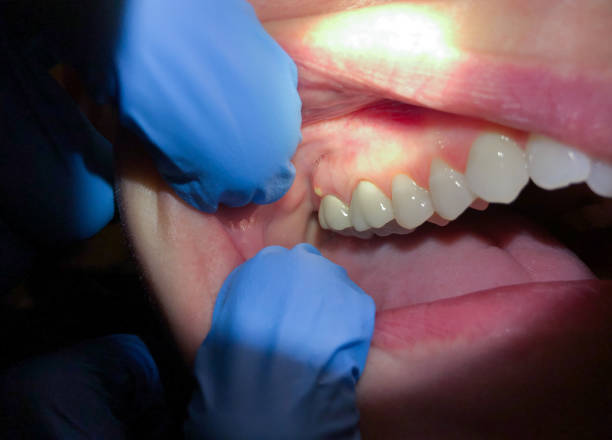Best Emergency Tooth Extraction in Wheeler, TX